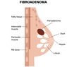 Fibroadenoma