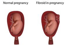 Apa Itu Fibroid Rahim? Ini Penyebab, Gejala, dan Komplikasinya