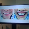Awas, Jangan Pasang Veneer Gigi di Sembarang Klinik