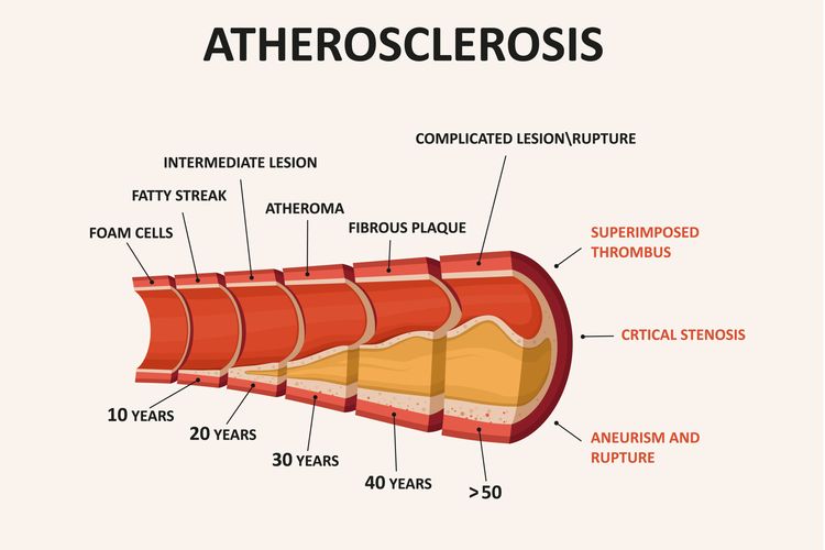 ilustrasi Aterosklerosis