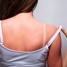 Tips Cepat Mengatasi Sunburn 