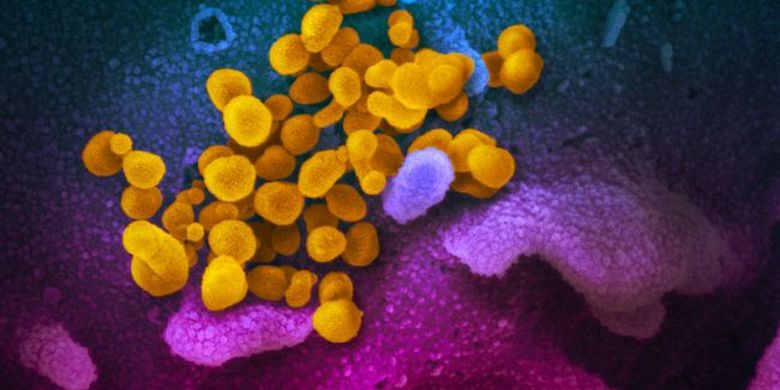 Gambar mikroskop elektron pemindai menunjukkan virus corona Wuhan atau Covid-19 (kuning) di antara sel manusia (biru, merah muda dan ungu). 