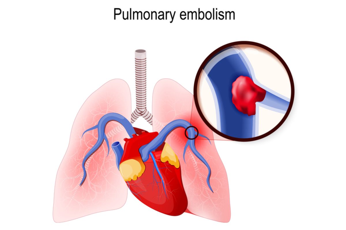 Ilustrasi Emboli Paru