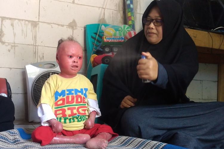 Muhammad Ridho Fauzi, bocah penderita sindrom harlequin ichthyosis bersama ibunya Siti Nur Endah di rumahnya di Desa Kaliori, Kecamatan Kalibagor, Kabupaten Banyumas, Jawa Tengah, Selasa (14/1/2029).