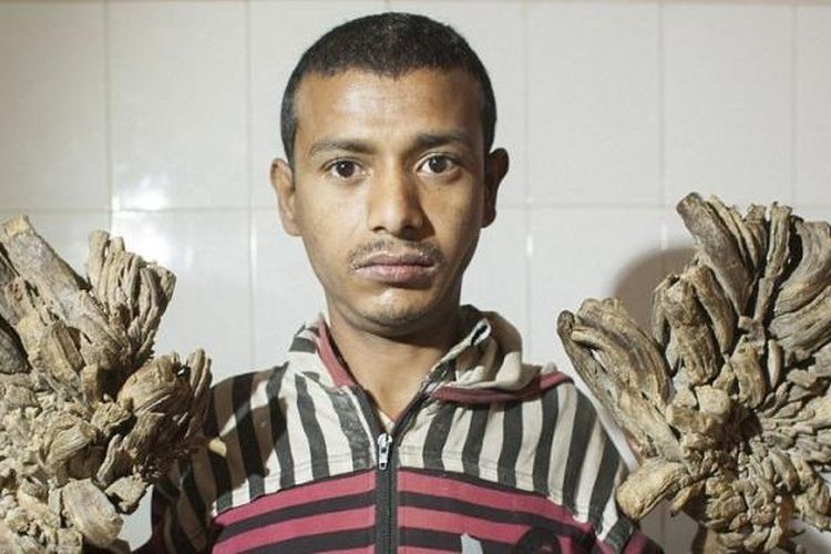Pria asal Banglades ini juga mengalami kondisi langka seperti Dede Koswara asal Bandung, Indonesia yang dijuluki 'Manusia Akar'