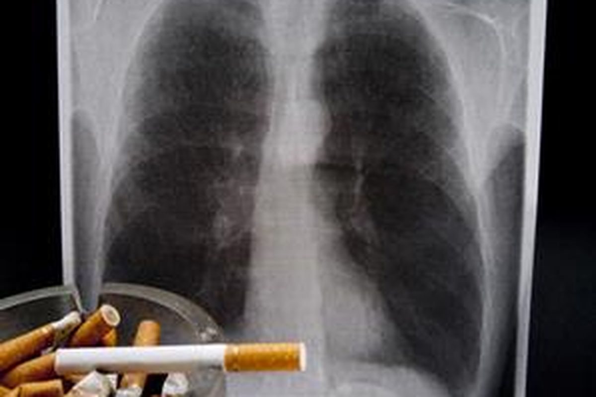 Ilustrasi paru-paru milik perokok.