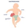 Gastroschisis