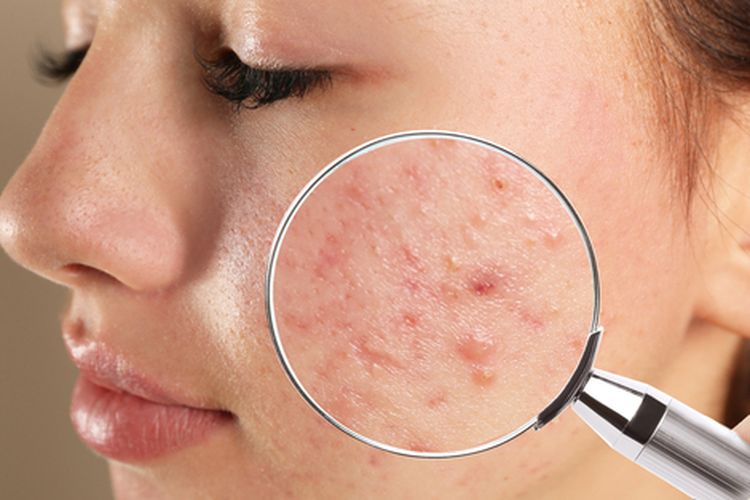 Mengetahui apa itu rosacea sangatlah penting agar bisa mendapatkan perawatan dengan segera.