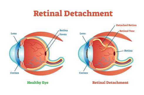 Ablasi Retina