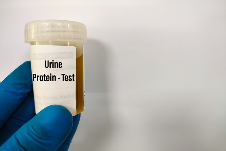 Ilustrasi protein urine, penyebab protein urine tinggi, pemeriksaan protein urine