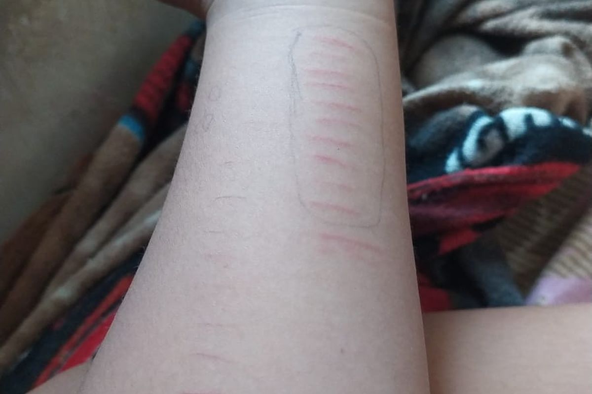 Foto: Tangan siswa SD di Situbondo menyayat sendiri tangnnya dengan senjata tajam.