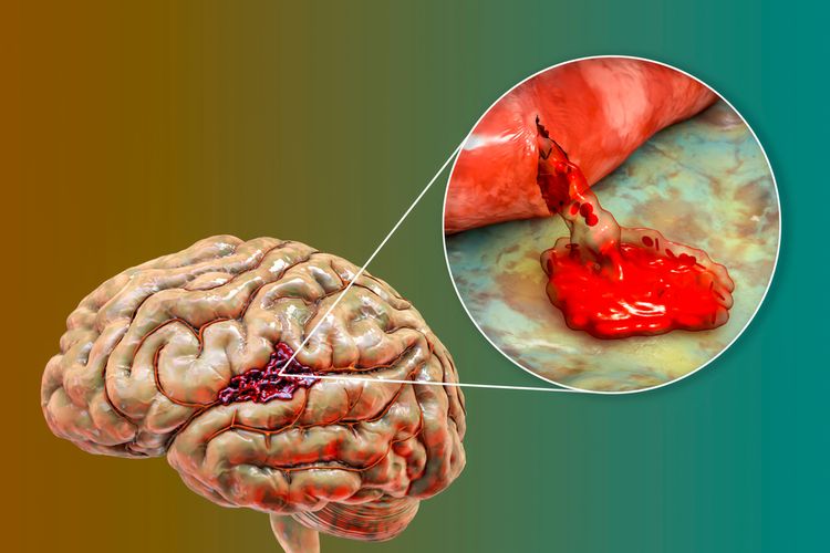 4 Jenis Pendarahan Otak yang Pantang Disepelekan