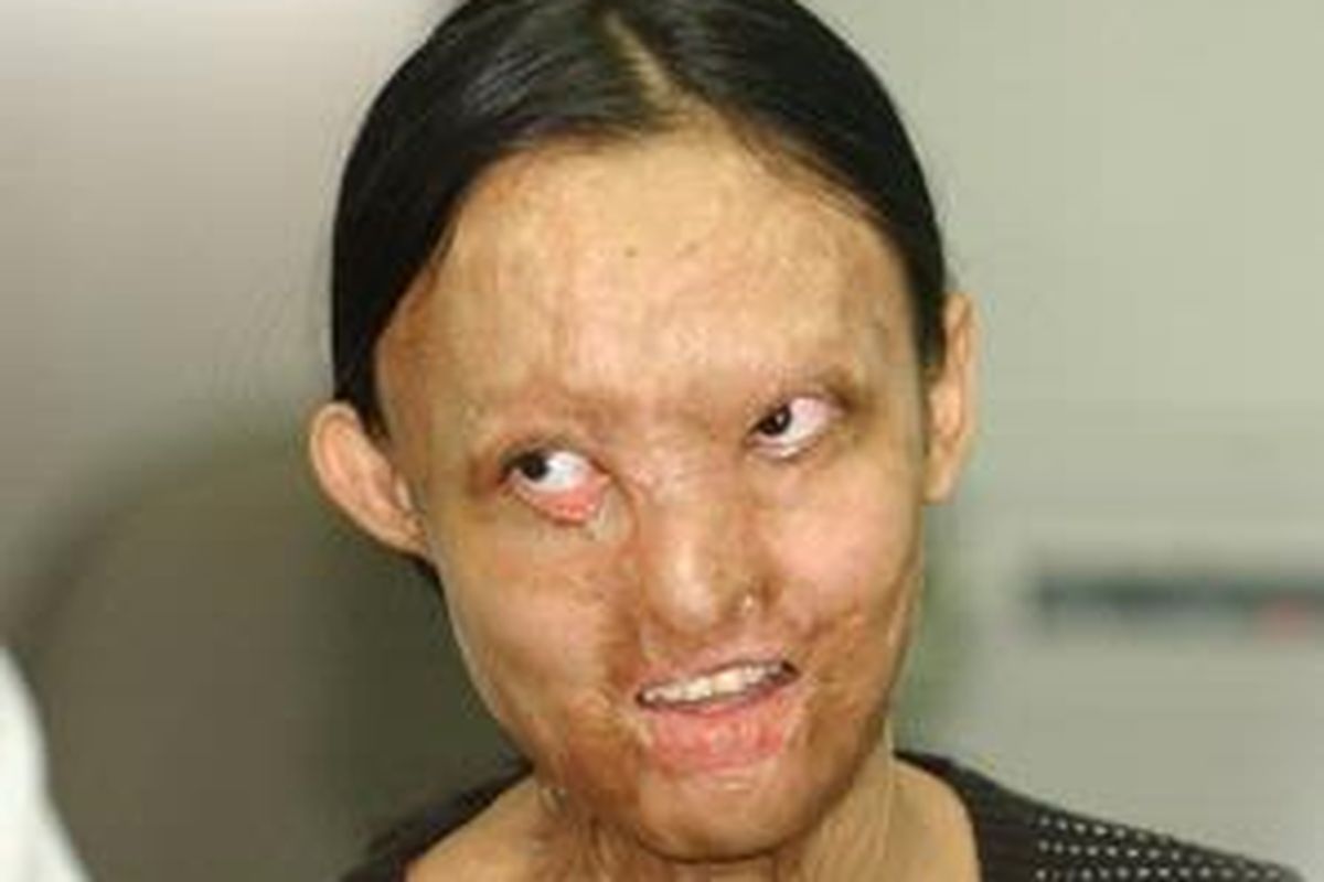 Nurjazilah alias Lisa setelah mengalami penganiayaan oleh suaminya, Mulyono. Kini Lisa dirawat di RSU Dr Soetomo Surabaya.