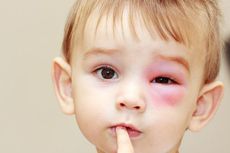 Anak Alergi Sejak Kecil? Kenali Dampak Kesehatan sampai Psikologisnya