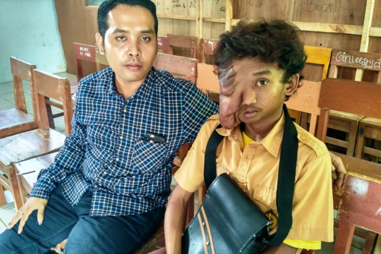 Ahmad Romadhon (kanan), asal Dusun Pucungsari, Desa Kajoran, Kecamatan Kajoran, Kabupaten Magelang, menderita tumor wajah sejak bayi. Penyakitnya terus membesar hingga menutup sebagian wajahnya.