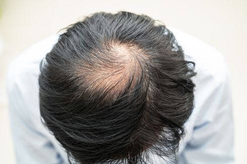 Pengobatan Terkini untuk Cegah Kebotakan karena Rambut Rontok