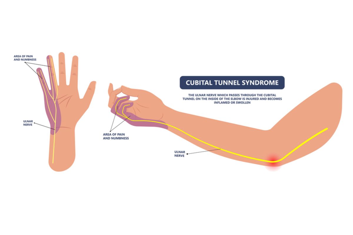 Ilustrasi sindrom terowongan kubital atau cubital tunnel syndrome