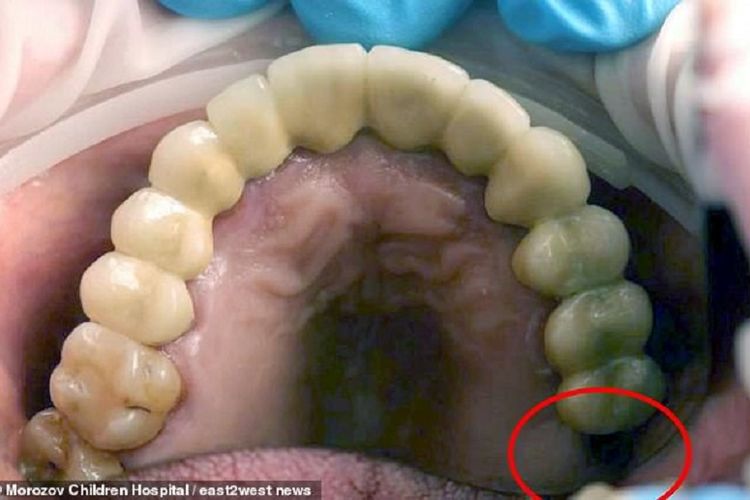 Gambar yang dirilis Rumah Sakit Anak Morozov, Rusia, menunjukkan gigi yang menghilang dari geraham, dan diketahui tumbuh di buah zakar remaja 13 tahun.
