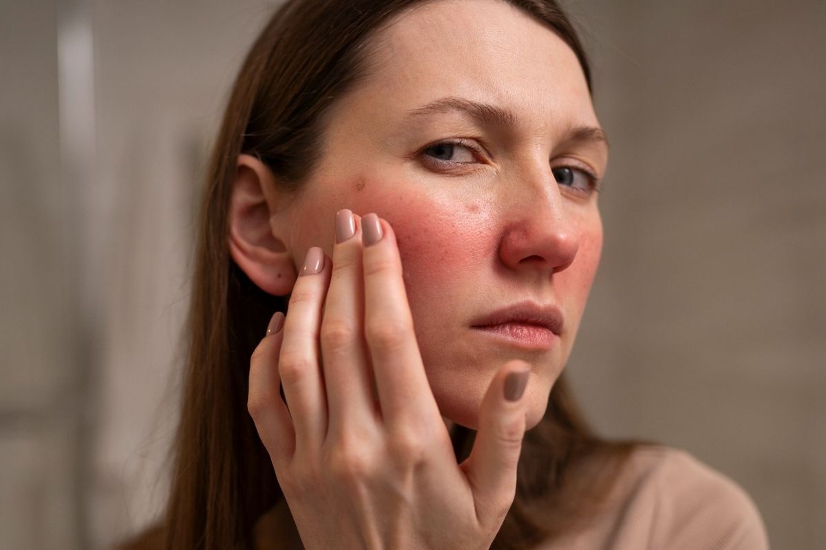 Ilustrasi rosacea.