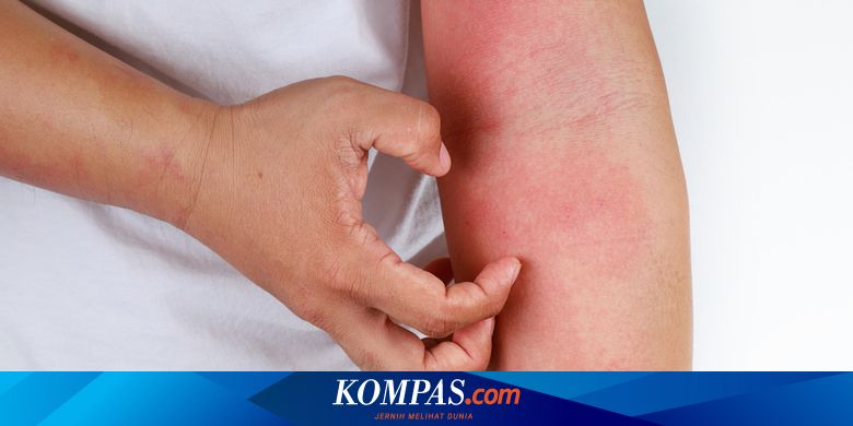 Gatal Dan Kulit Kering Bisa Jadi Pertanda Dermatitis Atopik