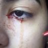 Gadis Ini Benar-benar Menangis Darah, Dokter Kesulitan Temukan Penyebabnya