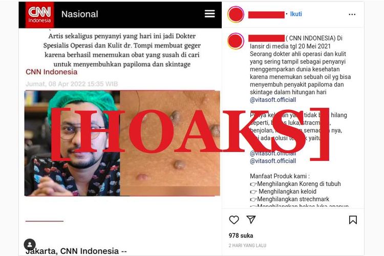 Hoaks dr Tompi membuat geger menemukan obat untuk papiloma dan skin tag pada kulit