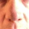 10 Cara Ampuh Hilangkan Komedo Hitam di Hidung Secara Alami
