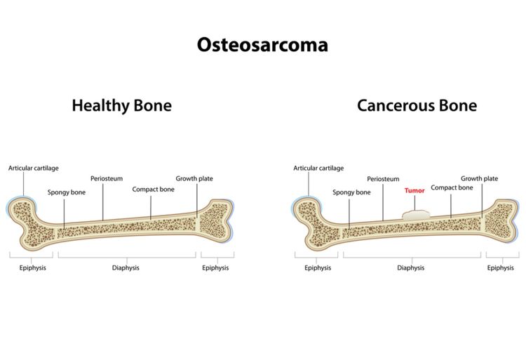 Ilustrasi osteosarkoma