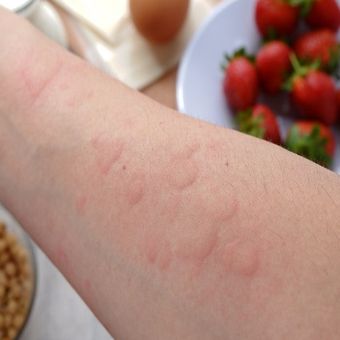 Ilustrasi alergi 