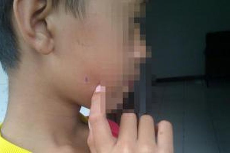 SCL (11), siswa SDN di Kota Malang, Jawa Timur, yang dipukul dan dicubit gurunya hingga terluka. Guru bersangkuta dilaporkan ke polisi.Jumat (5/9/2014).