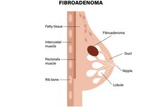 Fibroadenoma