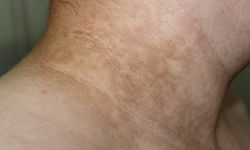 Bukan Malas Mandi, Area Gelap di Kulit Bisa Jadi Tanda Diabetes