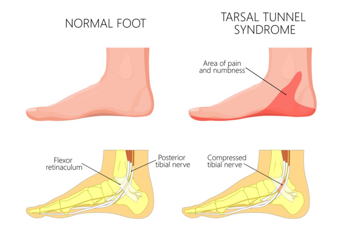 Ilustrasi sindrom terowongan tarsal