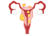 Mengenal Fibroid, Gejala, Penyebab, Faktor Risiko, dan Pengobatannya