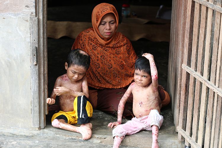 Radiansyah (11) dan adiknya Wulan Zaskia (5) menderita penyakit kulit bawaah lahir anak dari keluarga miskin warga Desa Geulanggang Meunjee, Kacamatan Kuta Blang, Kabupaten Bireun Aceh kondisinya sangat memprihatinkan, seluruh kulit ditubuhnya telah terkelupas dan luka akibat tak ada penanganan medis, Selasa (14/11/17)