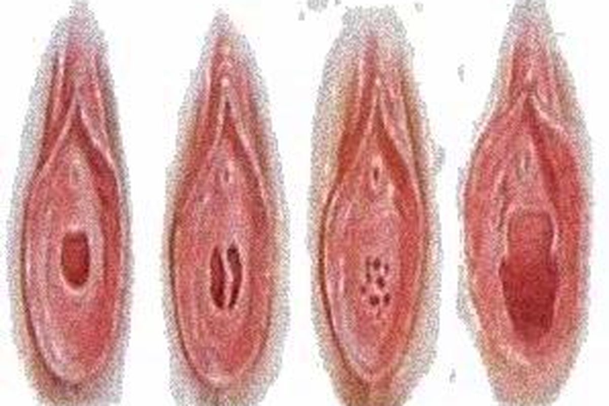  Jenis selaput dara berdasarkan bentuknya. Dari kiri ke kanan : Annular, Septate, Cibriform, Introitus.