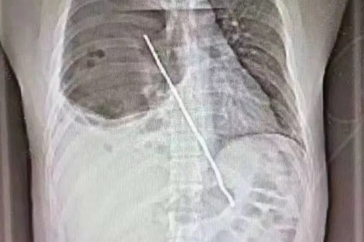 Inilah penampakan bagian dalam organ Zhang, seorang pria di China yang menelan tusuk sate dari besi 10 hari sebelumnya, membuat tenggorokan dan paru-parunya tertembus.
