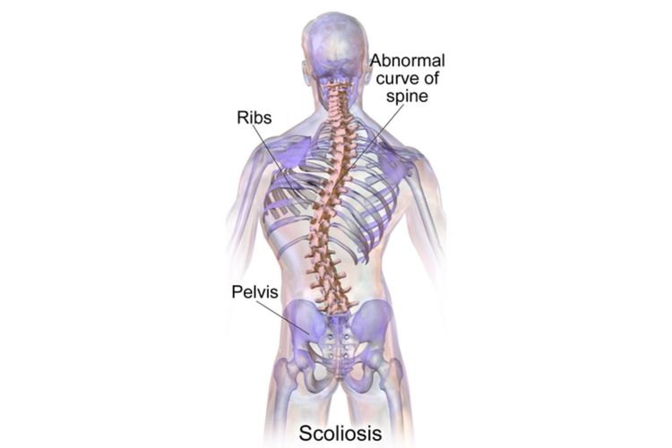 Skoliosis adalah salah satu jenis kelainan tulang belakang, di mana kondisi tulangnya terlihat menyamping atau seperti membentuk huruf S atau C.