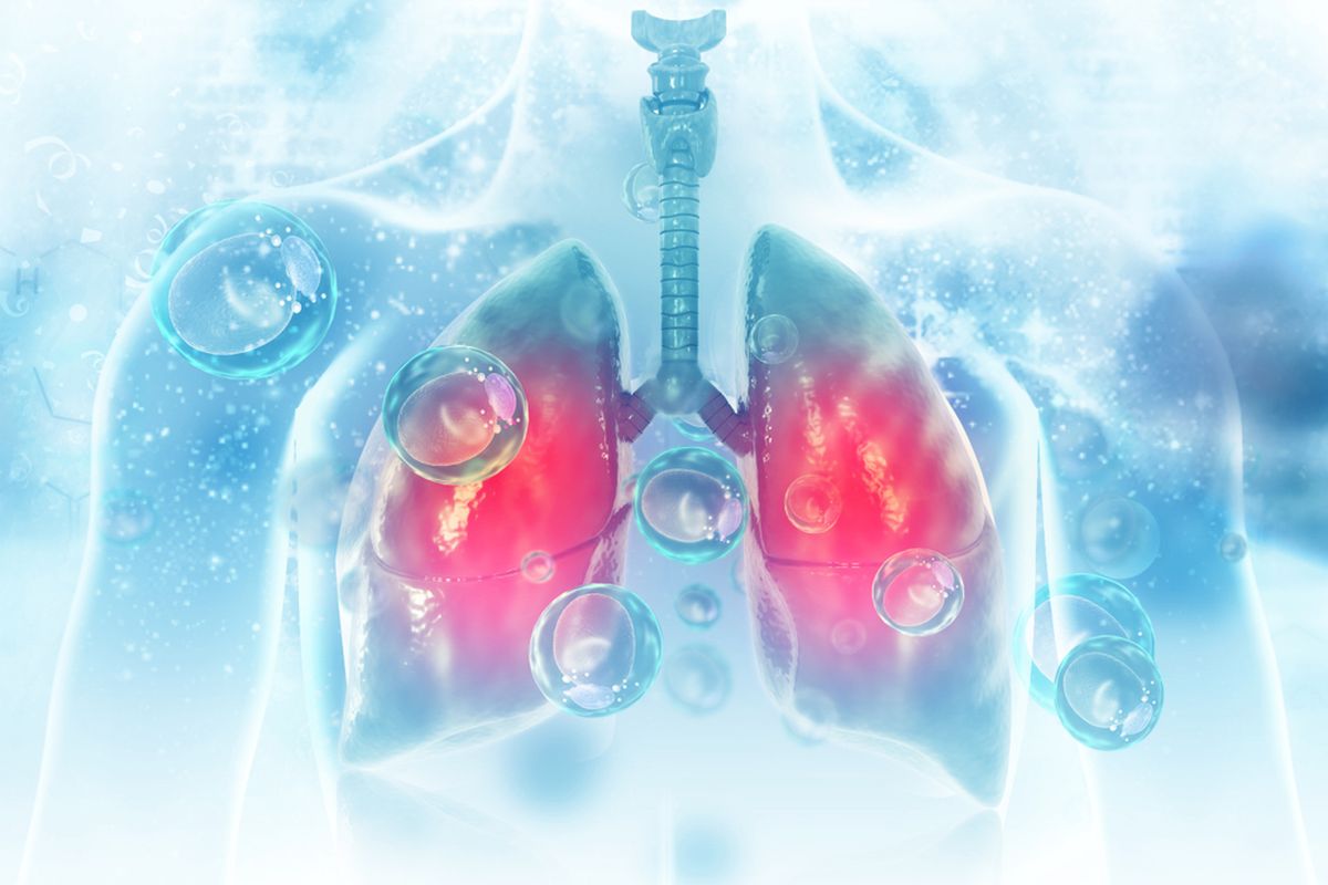 Ilustrasi pneumonia, virus dan bakteri menginfeksi paru-paru manusia.