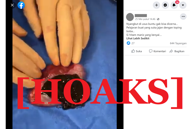 Tangkapan layar unggahan hoaks di sebuah akun Facebook, soal video yang diklaim sebagai usus buntu berisi boba yang tidak dapat dicerna.