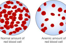 Anemia Defisiensi Besi pada Anak: Penyebab, Cara Mengetahui, dan Mencegah