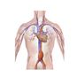Aneurisma Aorta