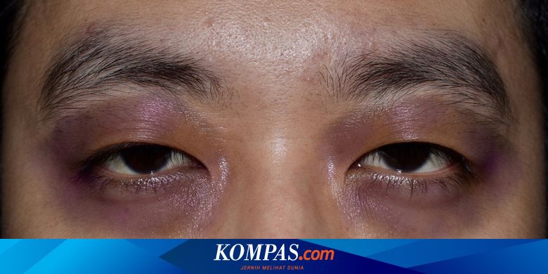 Berita Harian Gejala-raccoon-eye Terbaru Hari Ini - Kompas.com