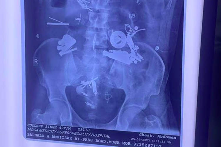 Hasil rontgen menunjukkan 150 benda asing di perut seorang pria di Rumah Sakit Medicity di Moga, Punjab, India.