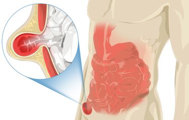 Ilustrasi hernia