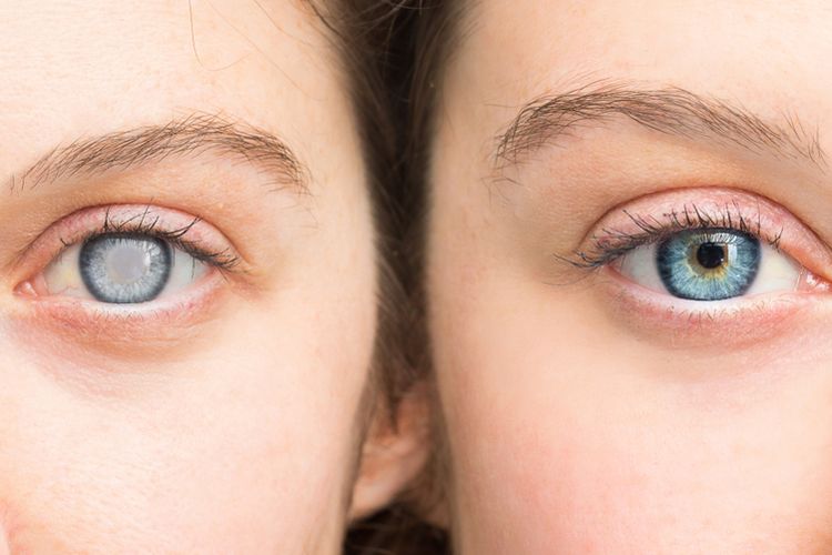Ilustrasi katarak pada mata orang sebelah kiri dibandingkan dengan mata normal pada orang sebelah kanan. Katarak adalah kekeruhan pada lensa mata, yang biasanya bening. Penglihatan kabur bisa jadi salah satu gejala awalnya. 