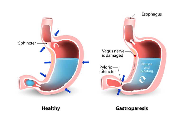 Ilustrasi Gastroparesis
