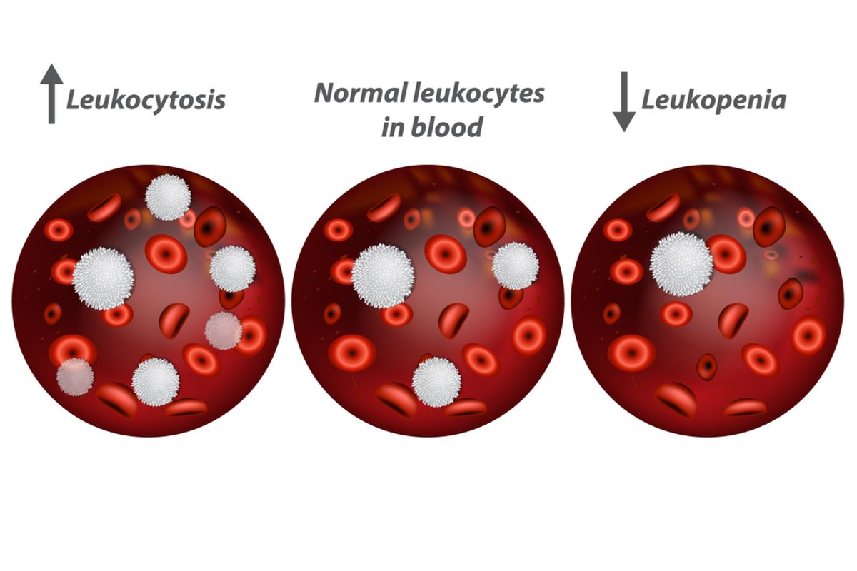 Ilustrasi leukositosis dan leukopenia