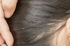 5 Akibat Kutu Rambut untuk Kesehatan dan Cara Menghilangkannya