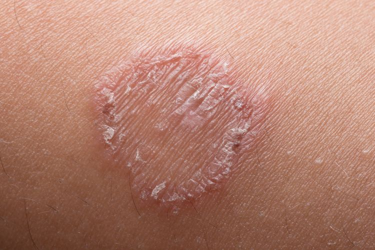 Mengenal Jamur Ringworm dan Cara Penularannya